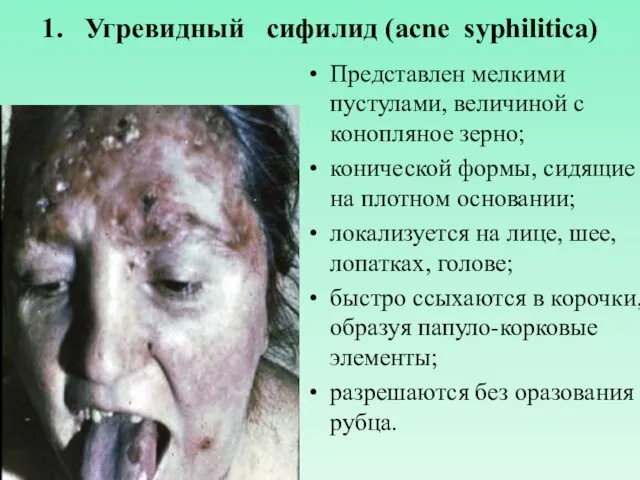 1. Угревидный сифилид (acne syphilitica) Представлен мелкими пустулами, величиной с конопляное зерно; конической