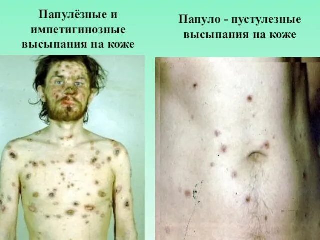 Папулёзные и импетигинозные высыпания на коже Папуло - пустулезные высыпания на коже
