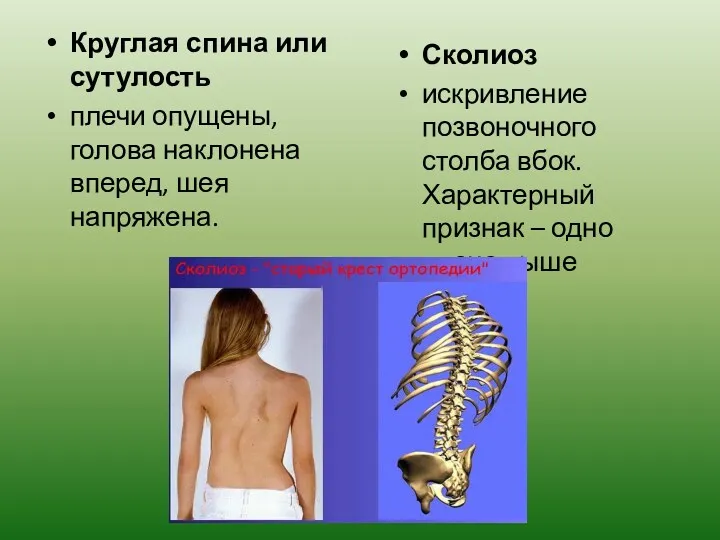 Круглая спина или сутулость плечи опущены, голова наклонена вперед, шея напряжена. Сколиоз искривление
