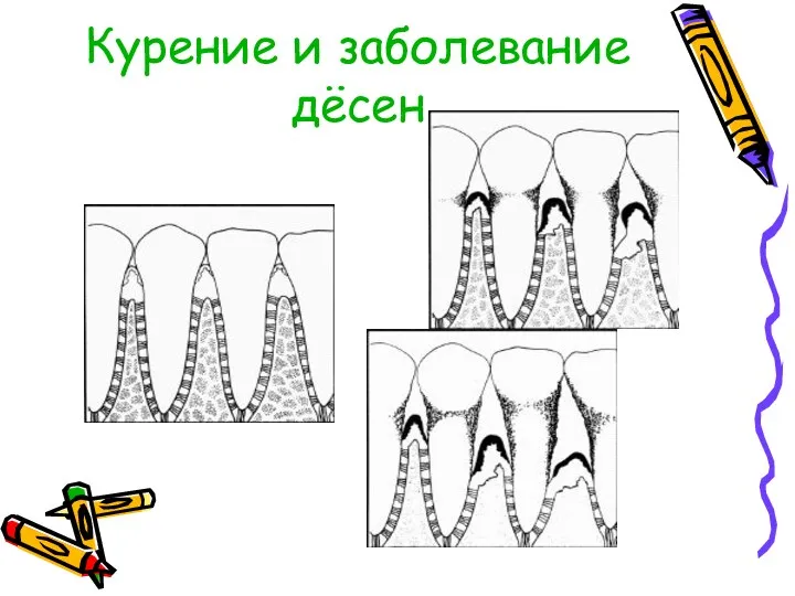 Курение и заболевание дёсен