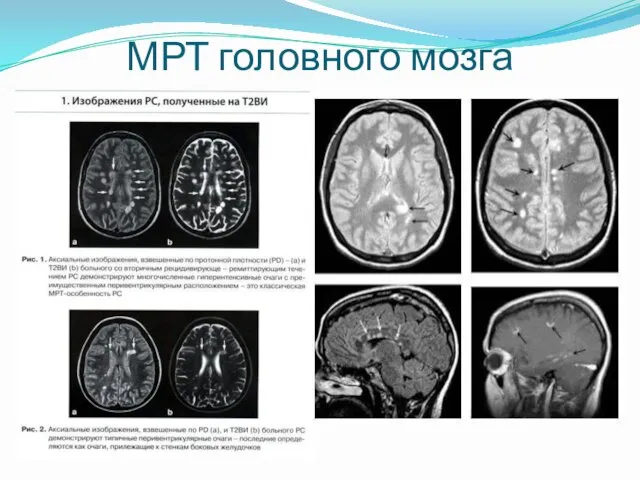 МРТ головного мозга