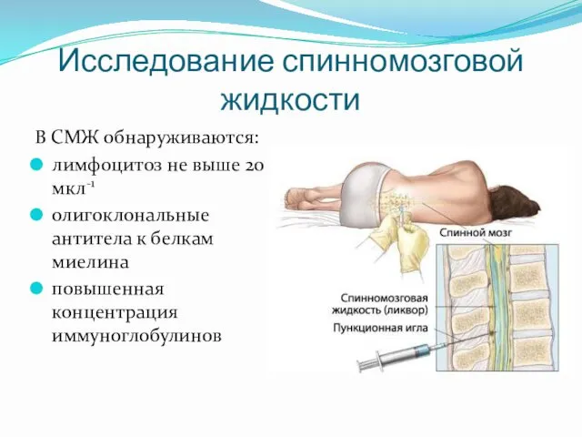 Исследование спинномозговой жидкости В СМЖ обнаруживаются: лимфоцитоз не выше 20