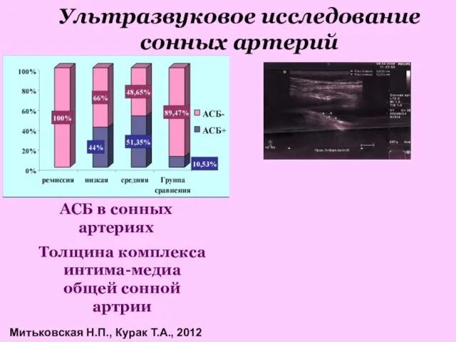 Ультразвуковое исследование сонных артерий АСБ в сонных артериях Толщина комплекса