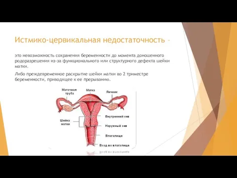 Истмико-цервикальная недостаточность – это невозможность сохранения беременности до момента доношенного