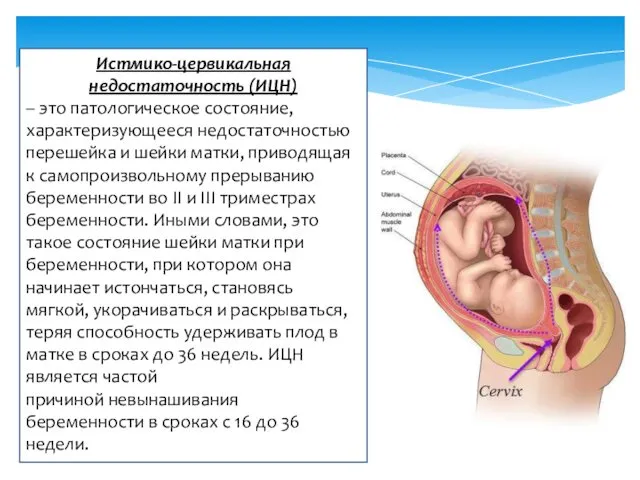 Истмико-цервикальная недостаточность (ИЦН) – это патологическое состояние, характеризующееся недостаточностью перешейка