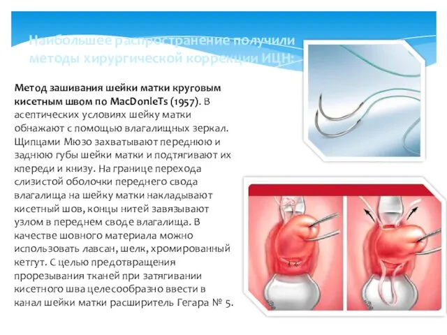 Наибольшее распространение получили методы хирургической коррекции ИЦН: Метод зашивания шейки