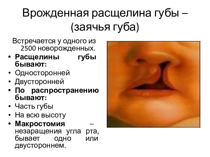 Врожденная расщелина губы – (заячья губа) Встречается у одного из