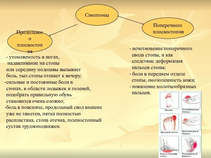 Симптомы Продольного плоскостопия Поперечного плоскостопия - утомляемость в ногах, надавливание