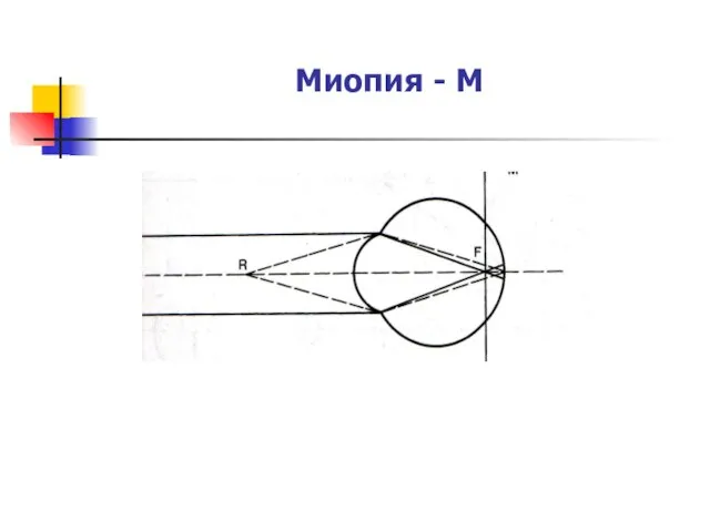 Миопия - М