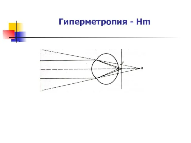 Гиперметропия - Hm