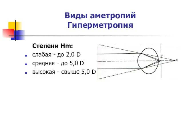 Виды аметропий Гиперметропия Cтепени Hm: слабая - до 2,0 D