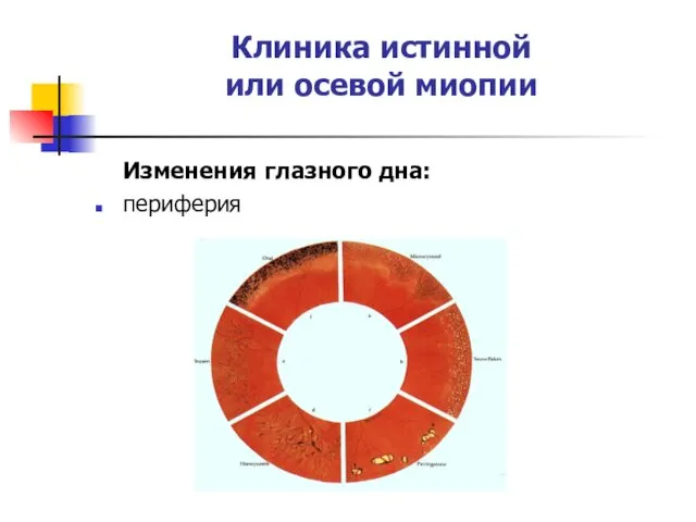 Клиника истинной или осевой миопии Изменения глазного дна: периферия