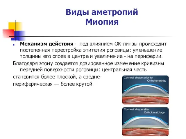 Виды аметропий Миопия Механизм действия – под влиянием ОК-линзы происходит