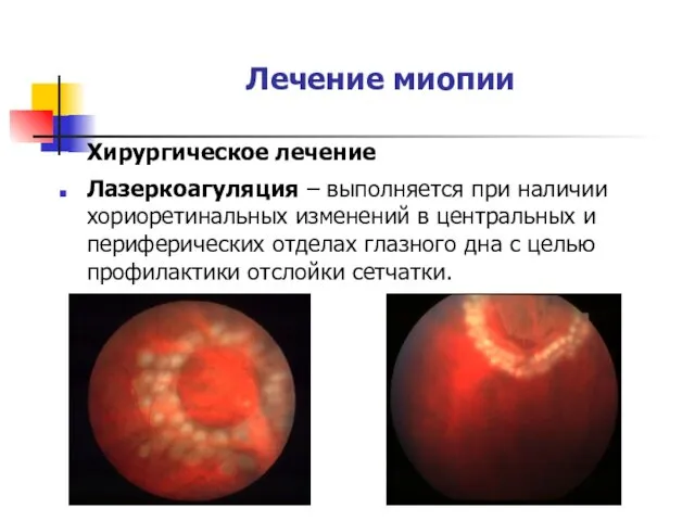 Лечение миопии Хирургическое лечение Лазеркоагуляция – выполняется при наличии хориоретинальных