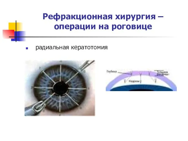 Рефракционная хирургия – операции на роговице радиальная кератотомия