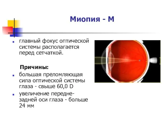 Миопия - М главный фокус оптической системы располагается перед сетчаткой.