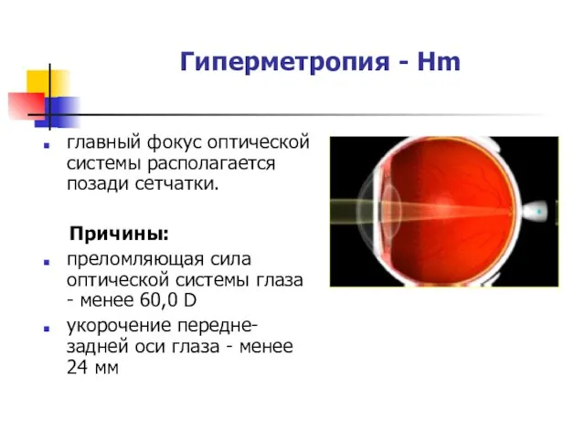 Гиперметропия - Hm главный фокус оптической системы располагается позади сетчатки.