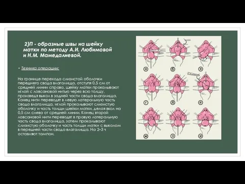 2)П - образные швы на шейку матки по методу А.И. Любимовой и Н.М.