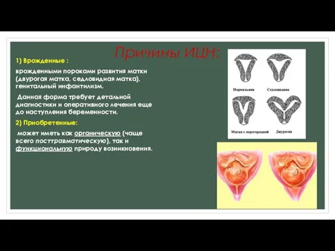 Причины ИЦН: 1) Врожденные : врожденными пороками развития матки (двурогая матка, седловидная матка),генитальный