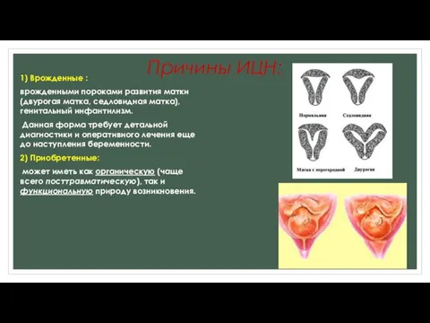 Причины ИЦН: 1) Врожденные : врожденными пороками развития матки (двурогая