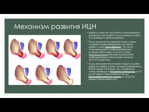 Механизм развития ИЦН Шейка матки не способна сопротивляться давлению растущего