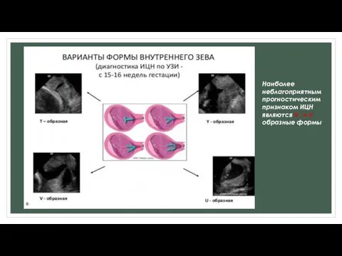 Наиболее неблагоприятным прогностическим признаком ИЦН являются V- и U образные формы