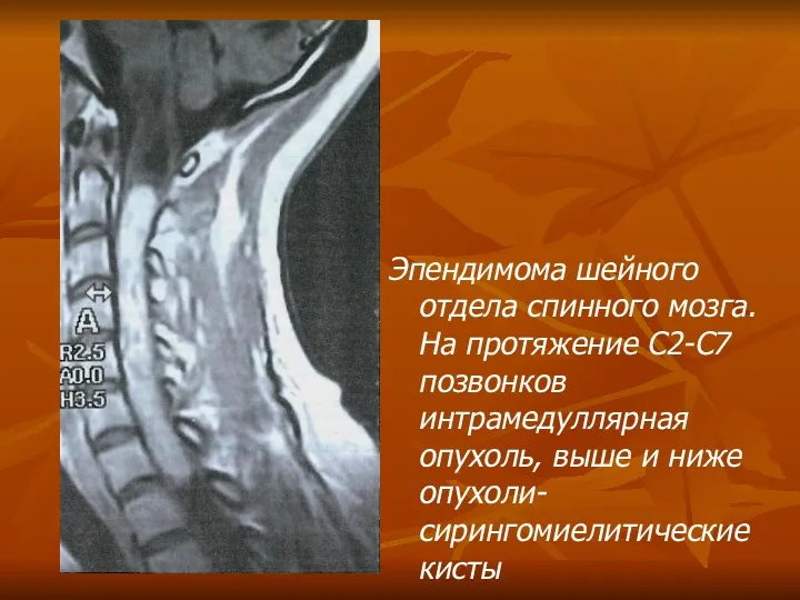 Эпендимома шейного отдела спинного мозга. На протяжение С2-С7 позвонков интрамедуллярная опухоль, выше и ниже опухоли-сирингомиелитические кисты