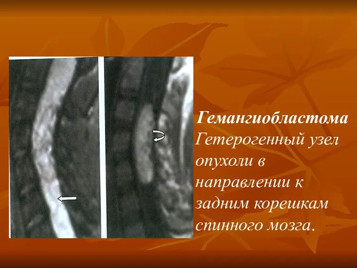 Гемангиобластома Гетерогенный узел опухоли в направлении к задним корешкам спинного мозга.