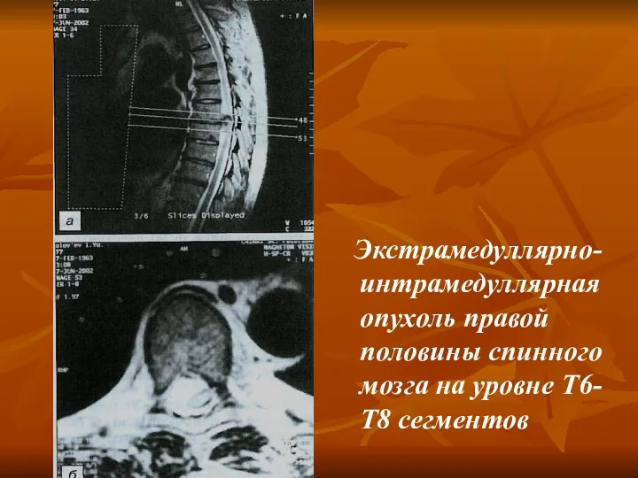 Экстрамедуллярно-интрамедуллярная опухоль правой половины спинного мозга на уровне Т6-Т8 сегментов