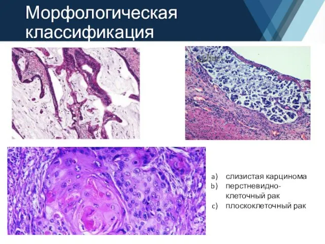 Морфологическая классификация слизистая карцинома перстневидно-клеточный рак плоскоклеточный рак
