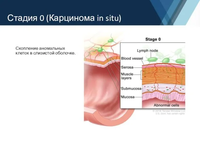 Стадия 0 (Карцинома in situ) Скопление аномальных клеток в слизистой оболочке.