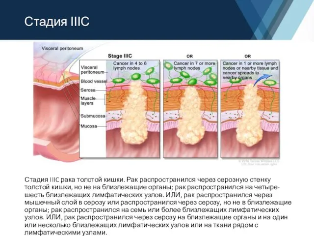 Стадия ΙΙΙС Стадия IIIC рака толстой кишки. Рак распространился через