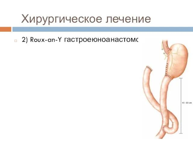 2) Roux-an-Y гастроеюноанастомоз Хирургическое лечение