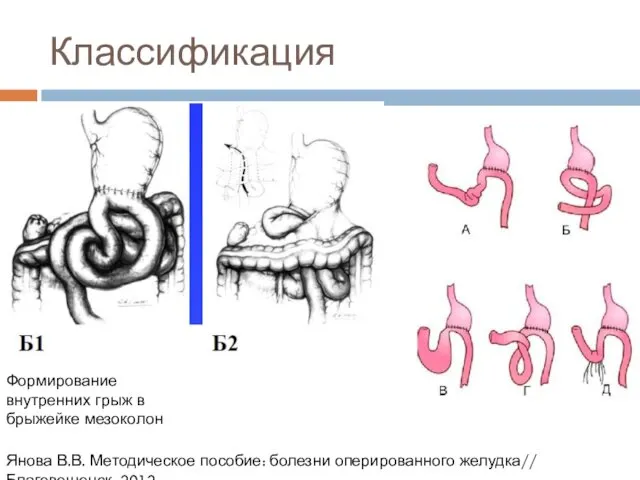 Классификация Формирование внутренних грыж в брыжейке мезоколон Янова В.В. Методическое пособие: болезни оперированного желудка// Благовещенск, 2012