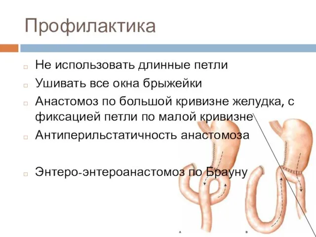 Профилактика Не использовать длинные петли Ушивать все окна брыжейки Анастомоз