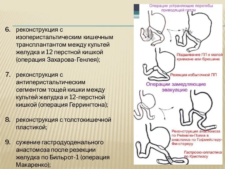 реконструкция с изоперистальтическим кишечным трансплантантом между культей желудка и 12