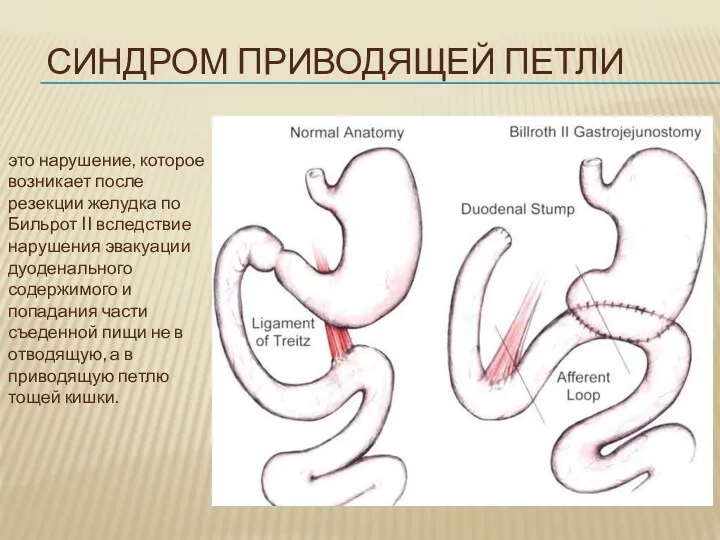 СИНДРОМ ПРИВОДЯЩЕЙ ПЕТЛИ это нарушение, которое возникает после резекции желудка