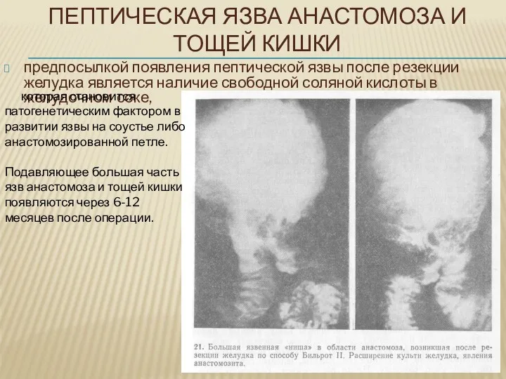 ПЕПТИЧЕСКАЯ ЯЗВА АНАСТОМОЗА И ТОЩЕЙ КИШКИ предпосылкой появления пептической язвы