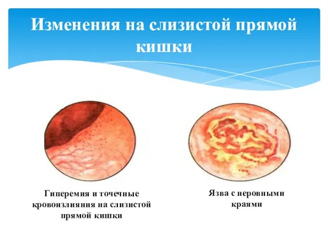 Изменения на слизистой прямой кишки Гиперемия и точечные кровоизлияния на слизистой прямой кишки