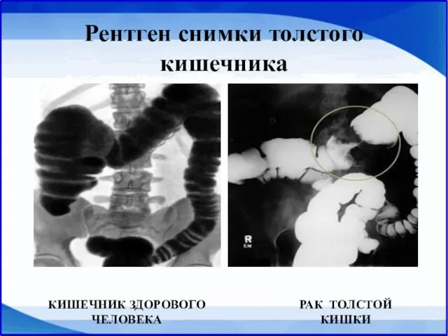 Рентген снимки толстого кишечника КИШЕЧНИК ЗДОРОВОГО ЧЕЛОВЕКА РАК ТОЛСТОЙ КИШКИ