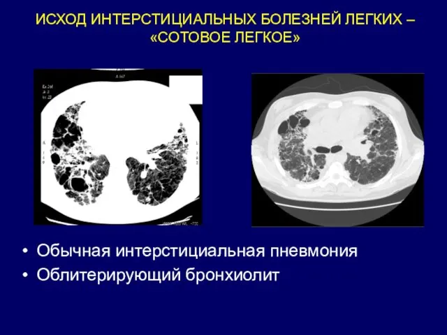 ИСХОД ИНТЕРСТИЦИАЛЬНЫХ БОЛЕЗНЕЙ ЛЕГКИХ – «СОТОВОЕ ЛЕГКОЕ» Обычная интерстициальная пневмония Облитерирующий бронхиолит