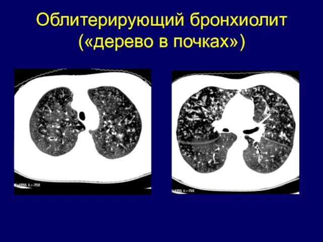 Облитерирующий бронхиолит («дерево в почках»)