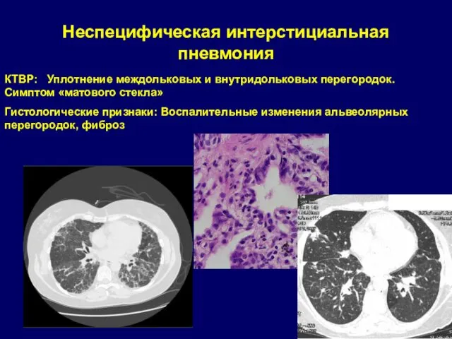 Неспецифическая интерстициальная пневмония КТВР: Уплотнение междольковых и внутридольковых перегородок. Симптом «матового стекла» Гистологические