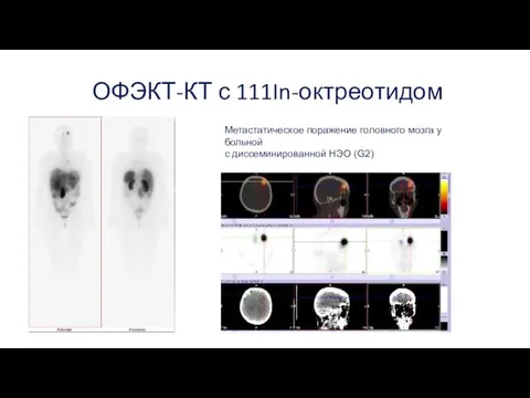 ОФЭКТ-КТ с 111In-октреотидом Метастатическое поражение головного мозга у больной с диссеминированной НЭО (G2)