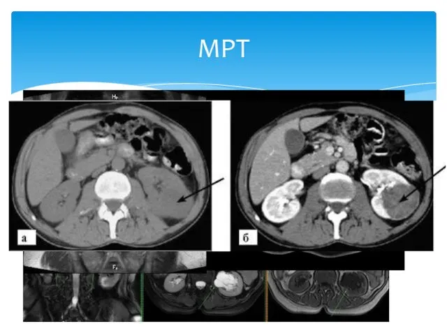 Более точное исследование Лучшая визуализация мягких тканей Различные патологии почек Оценка опухолевой прогрессии МРТ