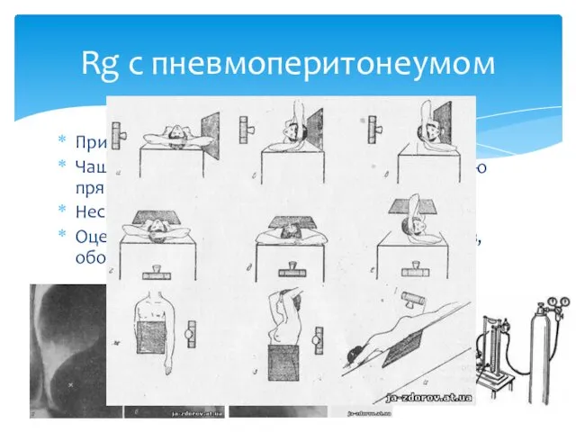 При онкологии Чаще слева в нижнем квадранте живота по краю