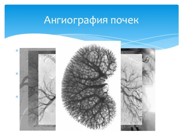 транслюмбальная и трансфеморальная аортография Два снимка в начале ввода, один