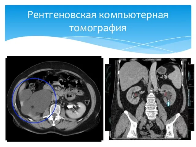 Более обширное исследование Циркулярная и спиральная Различные патологии почек, окружающих