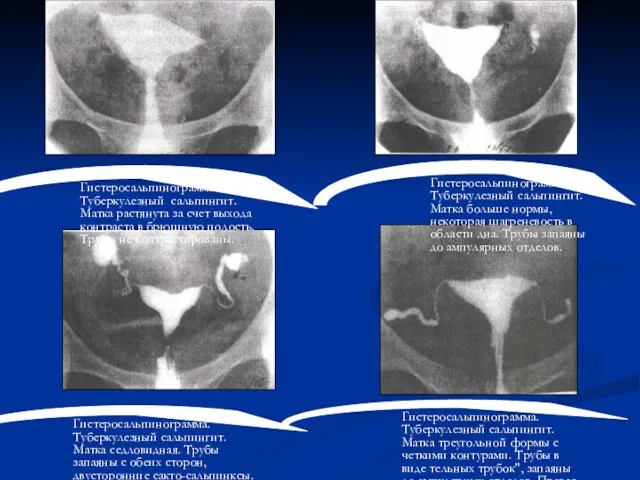 Гистеросальпинограмма. Туберкулезный сальпингит. Матка растянута за счет выхода контраста в