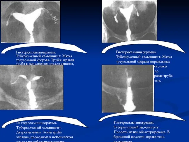 Гистеросальпинограмма. Туберкулезный сальпингит. Матка треугольной формы нормальных размеров, отклонена несколько
